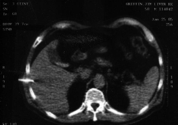 05-01-26 Biopsy